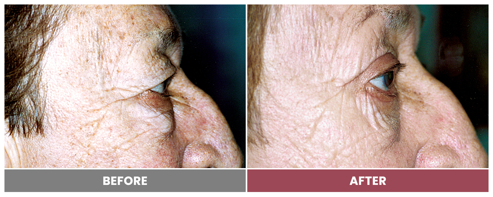 Upper Blepharoplasty - Case 13